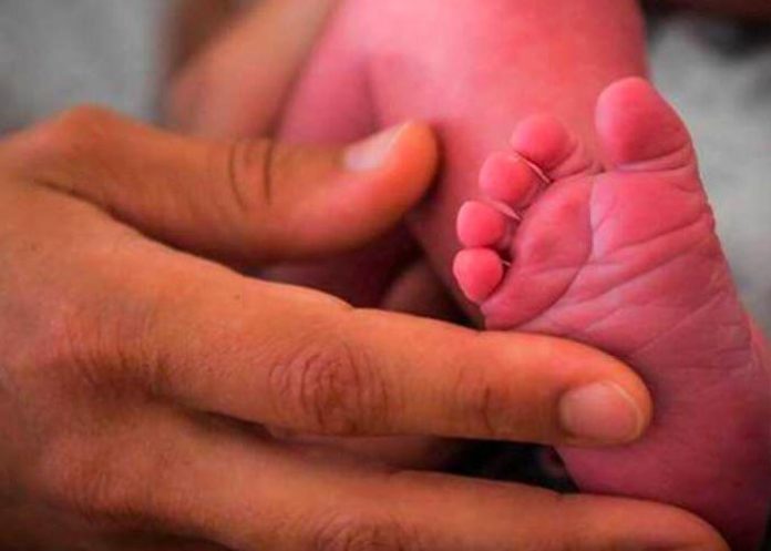 yemen Gemelos separados por 24 médicos en Yemen