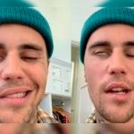 Síndrome de Ramsay Hunt que padece Bieber proviene de la varicela Síndrome de Ramsay Hunt que paralizó la cara de Bieber proviene de la varicela