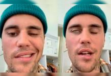 Síndrome de Ramsay Hunt que padece Bieber proviene de la varicela Síndrome de Ramsay Hunt que paralizó la cara de Bieber proviene de la varicela