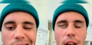 Síndrome de Ramsay Hunt que paralizó la cara de Bieber proviene de la varicela