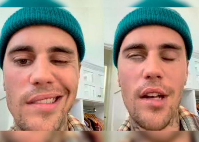 _1 Síndrome de Ramsay Hunt que paralizó la cara de Bieber proviene de la varicela