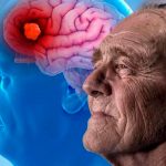 ¡Al fin! Alzheimer ya se puede detectar a tiempo con uso de escáner