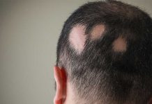 Un nuevo y prometedor medicamento contra la alopecia areata Un nuevo y prometedor medicamento contra la alopecia areata
