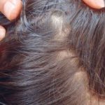 En EEUU: Madre y abuela dejan morir a niña llena de piojos En EEUU: Madre y abuela dejan morir a niña llena de piojos