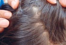 En EEUU: Madre y abuela dejan morir a niña llena de piojos En EEUU: Madre y abuela dejan morir a niña llena de piojos