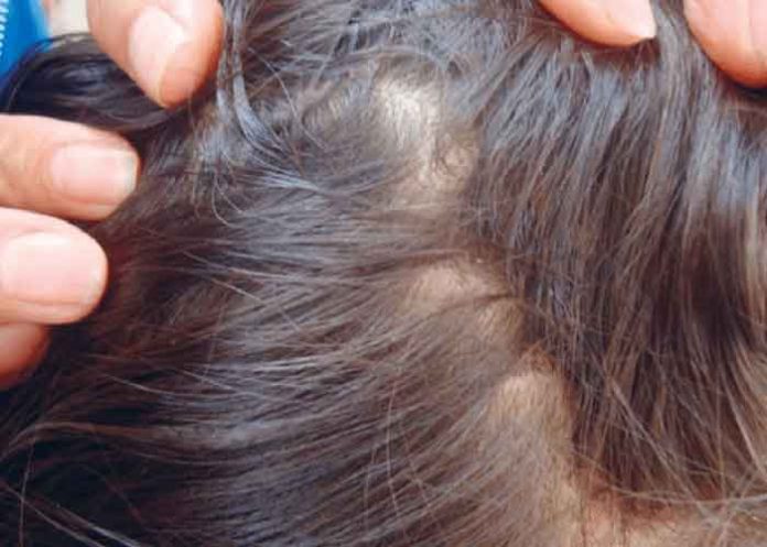 En EEUU: Madre y abuela dejan morir a niña llena de piojos