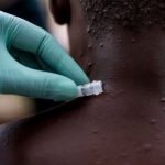 OMS reporta 760 casos positivos de viruela del mono en 27 países OMS reporta 760 casos positivos de viruela del mono en 27 países