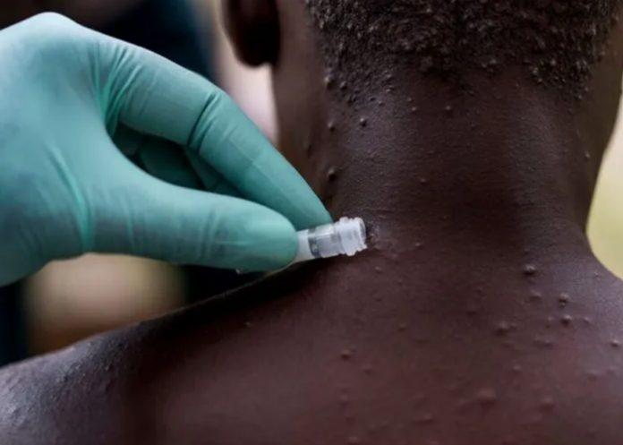 22 OMS reporta 760 casos positivos de viruela del mono en 27 países