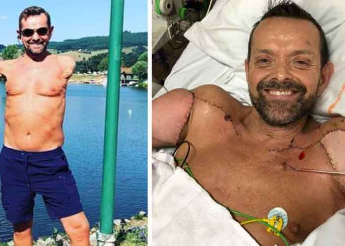 'Exitosa cirugía' le devuelve los brazos a hombre, Francia