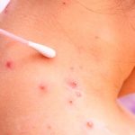 ¿Las erupciones que causa la viruela del mono dejan cicatrices? ¿Las erupciones que causa la viruela del mono dejan cicatrices?