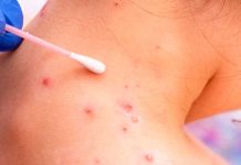 ¿Las erupciones que causa la viruela del mono dejan cicatrices? ¿Las erupciones que causa la viruela del mono dejan cicatrices?
