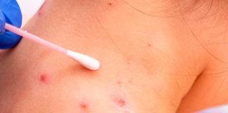 ¿Las erupciones que causa la viruela del mono dejan cicatrices?