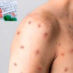 Autoridades confirman primer caso de viruela del mono en Brasil Autoridades confirman primer caso de viruela del mono en Brasil