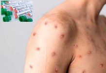 Autoridades confirman primer caso de viruela del mono en Brasil Autoridades confirman primer caso de viruela del mono en Brasil