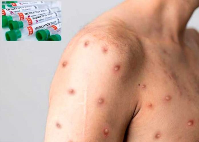 Autoridades confirman primer caso de viruela del mono en Brasil