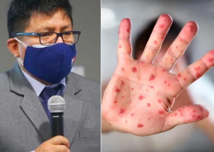 Perú está preparado para atender pacientes con Viruela