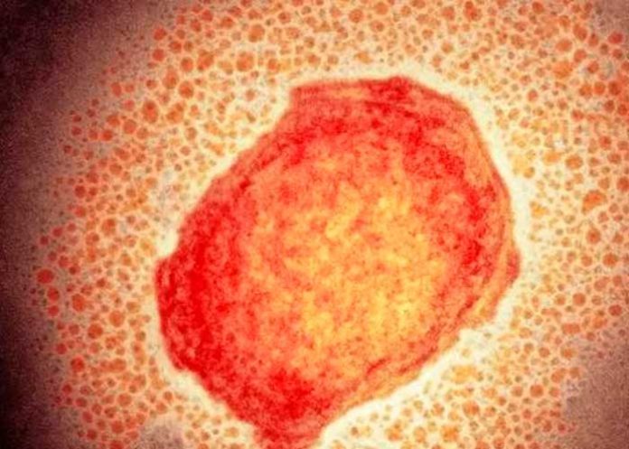 Entérate de otras enfermedades con síntomas similares a la viruela del mono