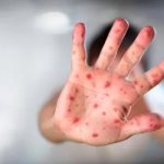 ¡Avanza! Viruela del mono en Portugal con 19 casos Portugal reporta 19 casos de viruela del mono