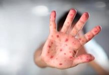 ¡Avanza! Viruela del mono en Portugal con 19 casos Portugal reporta 19 casos de viruela del mono