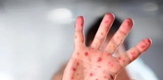 Portugal reporta 19 casos de viruela del mono