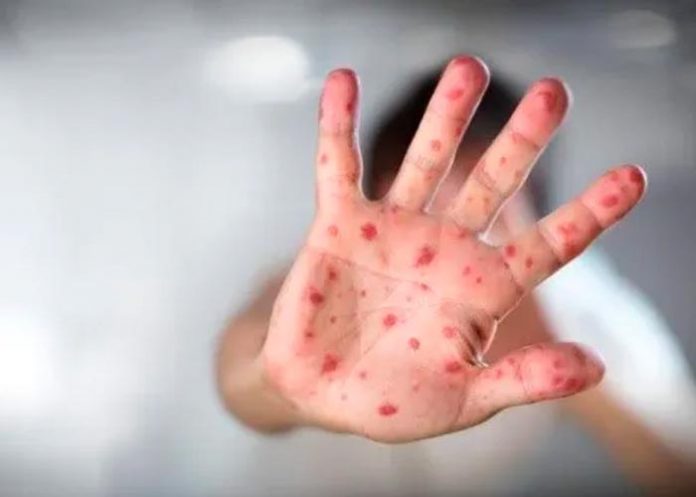 Portugal reporta 19 casos de viruela del mono