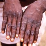 Aumentan 77% los casos de viruela del mono en una semana, dice la OMS Aumentan 77% los casos de viruela del mono en una semana, dice la OMS