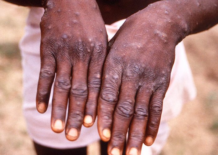 1 Aumentan 77% los casos de viruela del mono en una semana, dice la OMS