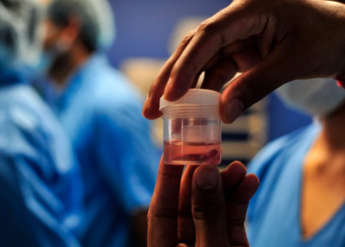 Registra 41 casos de la infección conocida como Hongo Negro en Honduras.