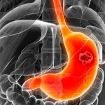 Síntomas y cómo prevenir el cáncer de estómago Síntomas y cómo prevenir el cáncer de estómago