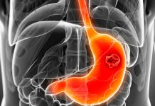 Síntomas y cómo prevenir el cáncer de estómago Síntomas y cómo prevenir el cáncer de estómago