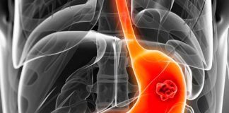 Síntomas y cómo prevenir el cáncer de estómago