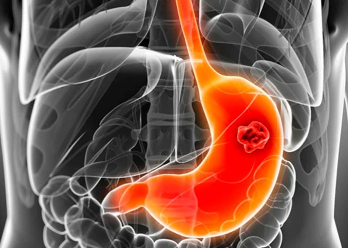 3 Síntomas y cómo prevenir el cáncer de estómago