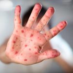 ¡Descubrimiento! Primeros brotes de viruela del mono en niños Reciente contagio de viruela del mono en España