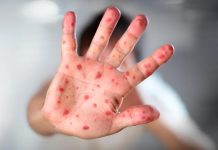 ¡Descubrimiento! Primeros brotes de viruela del mono en niños Reciente contagio de viruela del mono en España