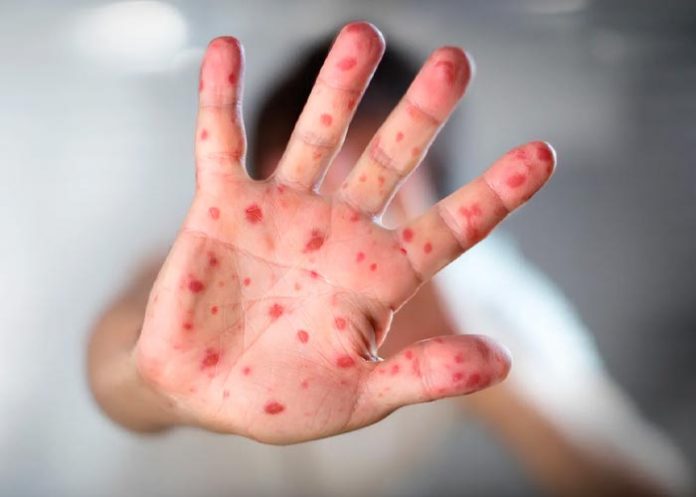 Reciente contagio de viruela del mono en España