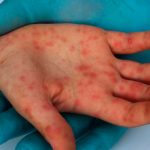 OMS afirma que la vacuna contra la viruela del mono demora en inmunizar OMS afirma que la vacuna contra la viruela del mono demora en inmunizar