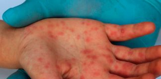 OMS afirma que la vacuna contra la viruela del mono demora en inmunizar