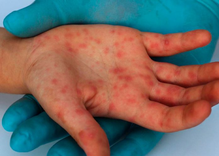 OMS afirma que la vacuna contra la viruela del mono demora en inmunizar