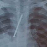 Un clavo en sus pulmones provoca la muerte de un niño en Brasil Un clavo en sus pulmones provoca la muerte de un niño en Brasil
