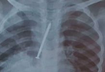 Un clavo en sus pulmones provoca la muerte de un niño en Brasil