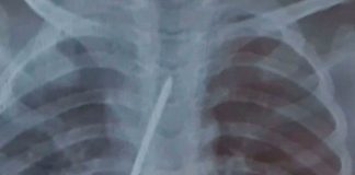 Un clavo en sus pulmones provoca la muerte de un niño en Brasil