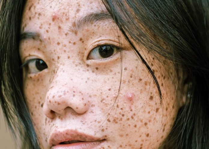 La ciencia demuestra que nadie nace con pecas