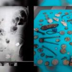 ¡Escalofriante! Encuentran más de 200 objetos en el estómago de un hombre ¡Escalofriante! Encuentran más de 200 objetos en el estómago de un hombre