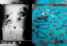 ¡Escalofriante! Encuentran más de 200 objetos en el estómago de un hombre