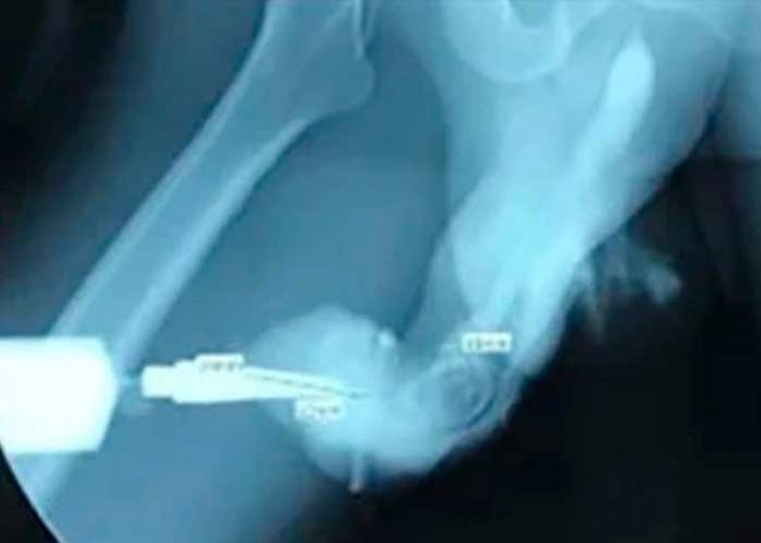 ¡Qué dolor! Hombre se quiebra el 