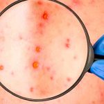 ¡Alerta! Descubren nuevos síntomas de la Viruela del mono