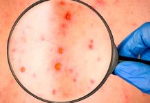 ¡Alerta! Descubren nuevos síntomas de la Viruela del mono