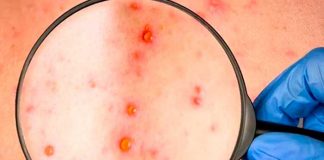 ¡Alerta! Descubren nuevos síntomas de la Viruela del mono