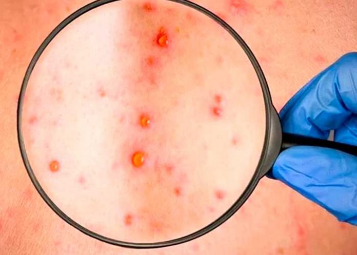 ¡Alerta! Descubren nuevos síntomas de la Viruela del mono