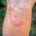 Confirman casos de fiebre hemorrágica de Crimea-Congo en España